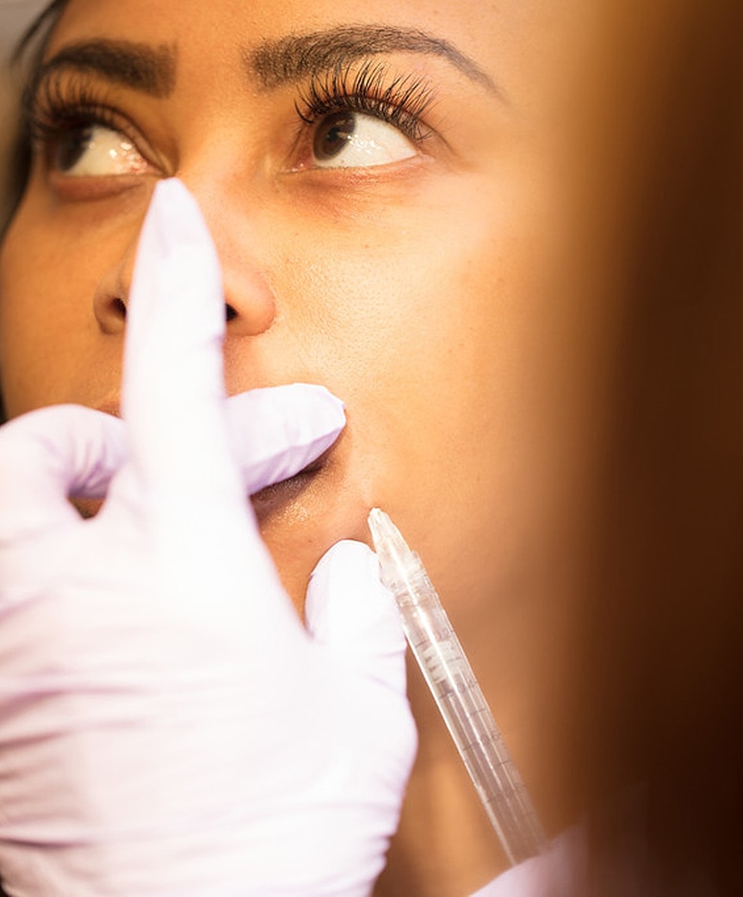 Chin Filler Baltimore | Maryland Facial Fillers | Dr. Michele Shermak