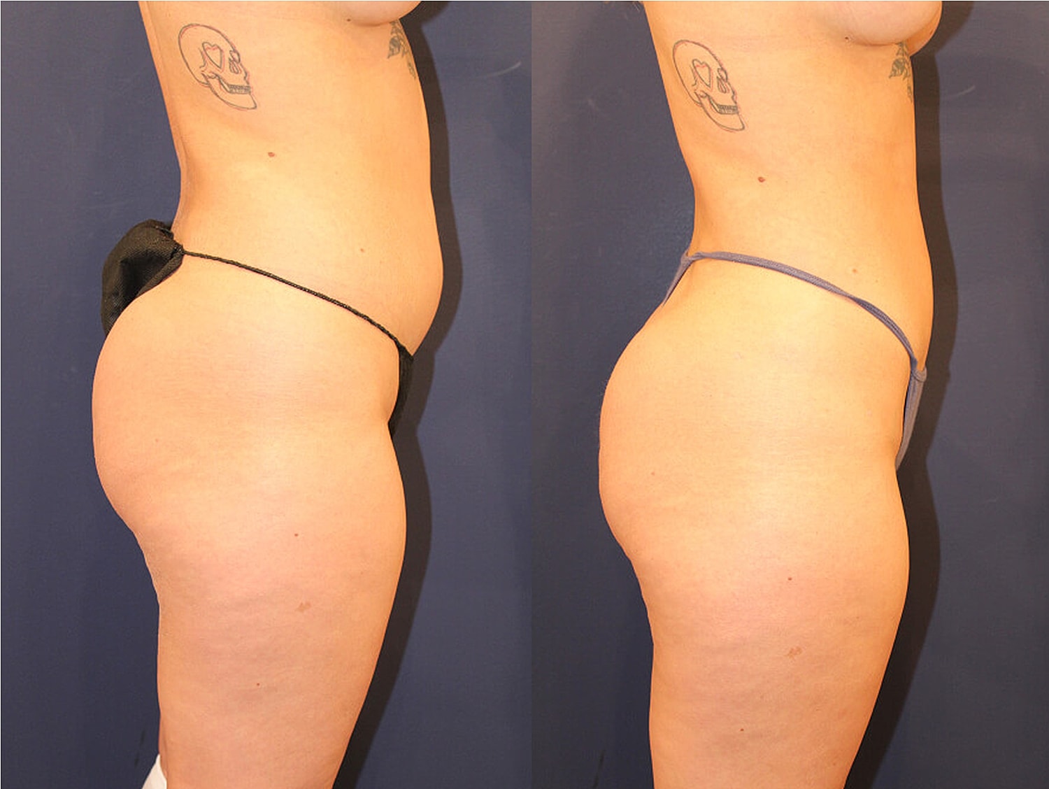 Before and after body contouring treatment comparison.