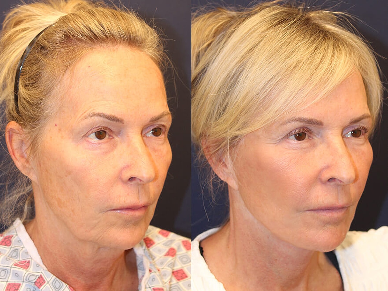 Before and after cosmetic treatment comparison photo.