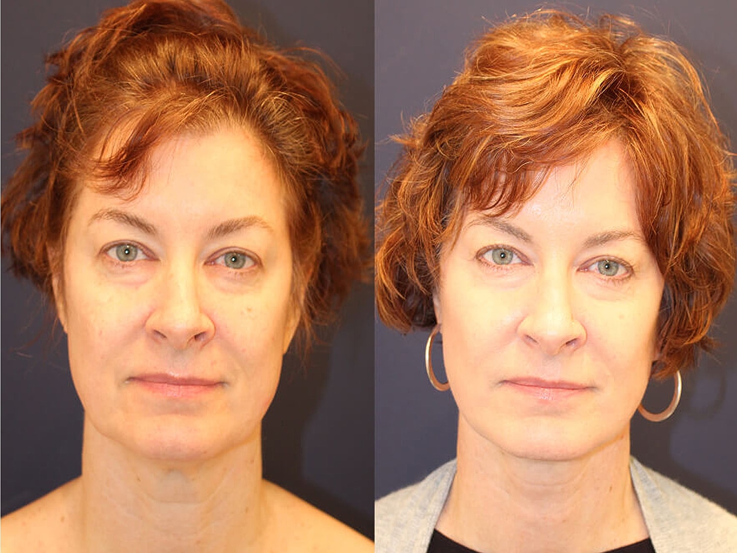 Before and after facial transformation comparison.
