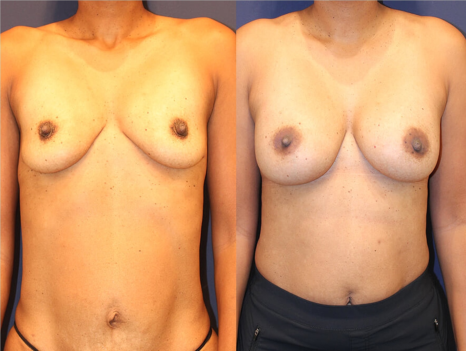 Before and after breast enhancement images.