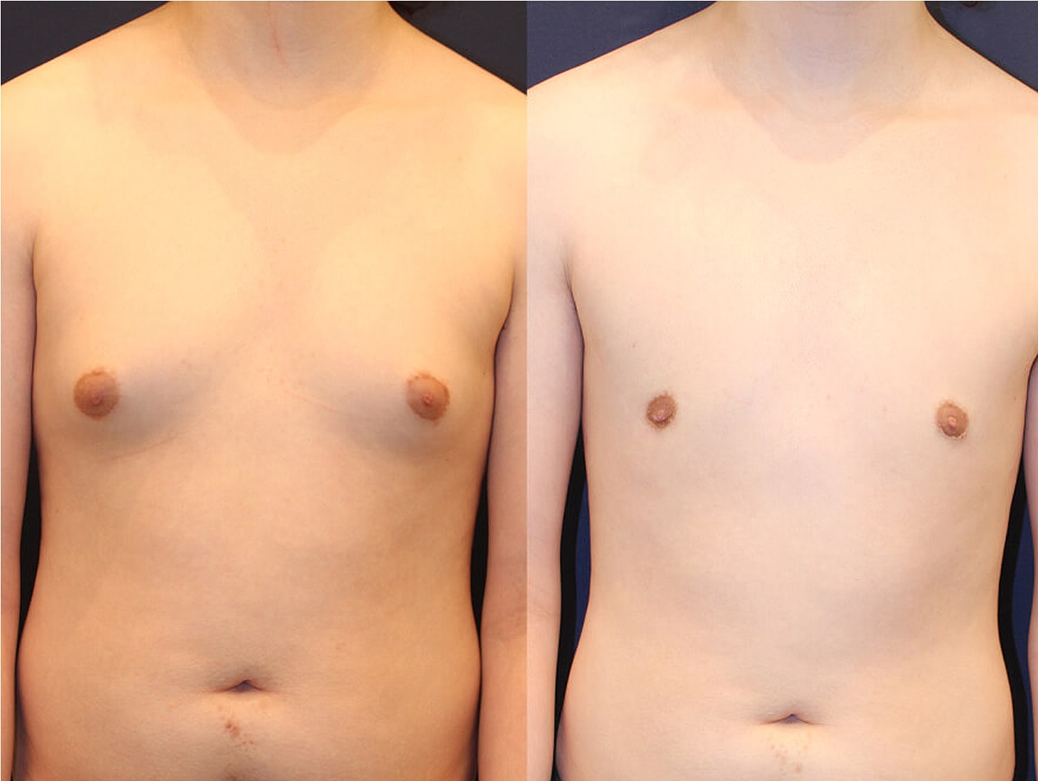 Before and after image of chest surgery.