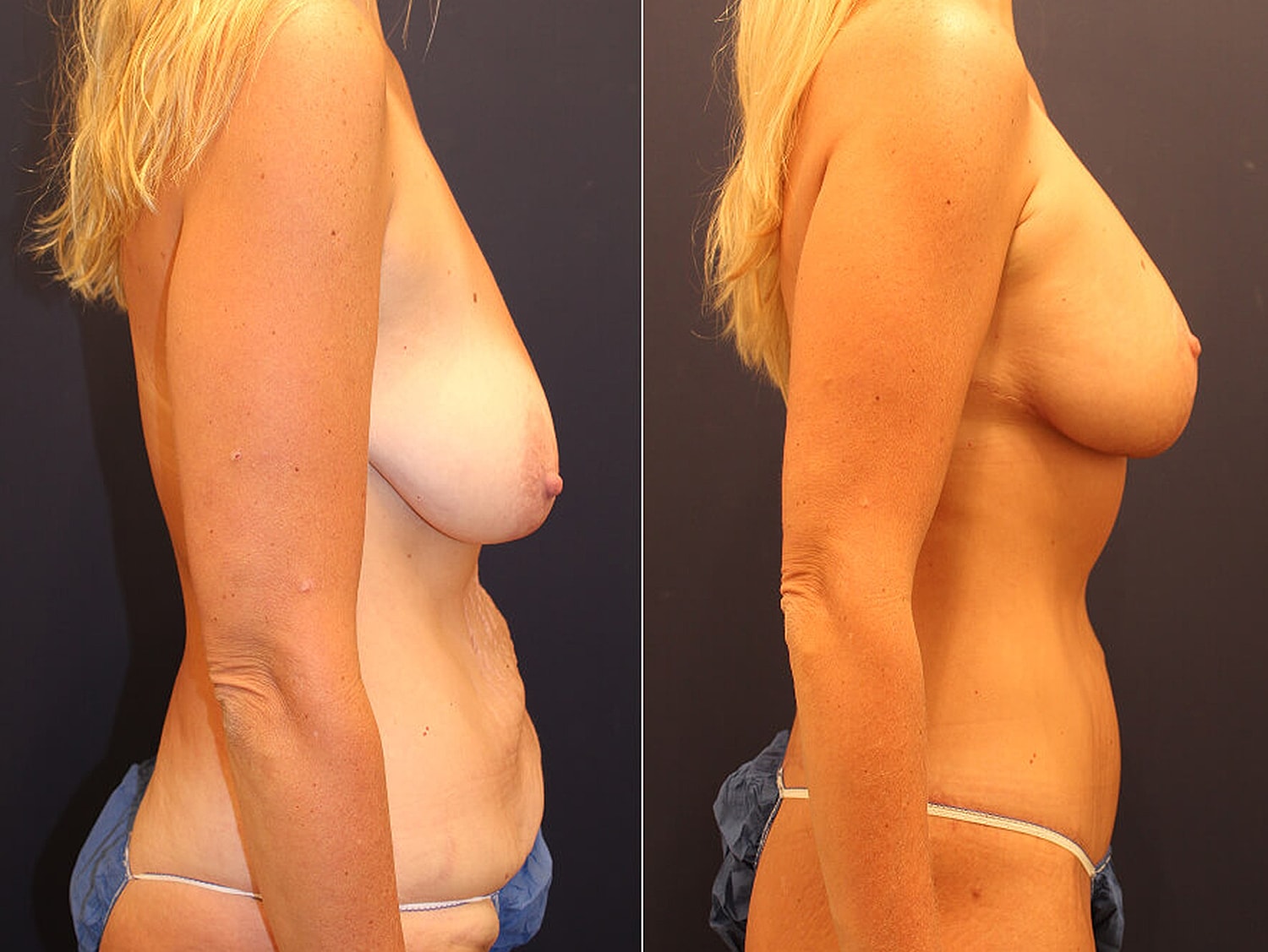 Before and after body transformation comparison.