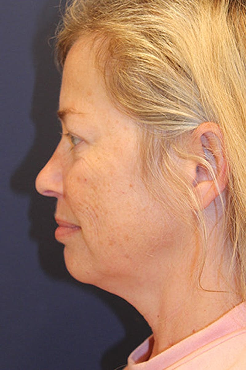 Facial Fat Graft Before & After