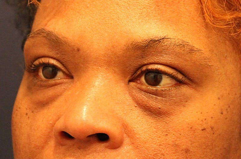 Facial Fat Graft Before & After