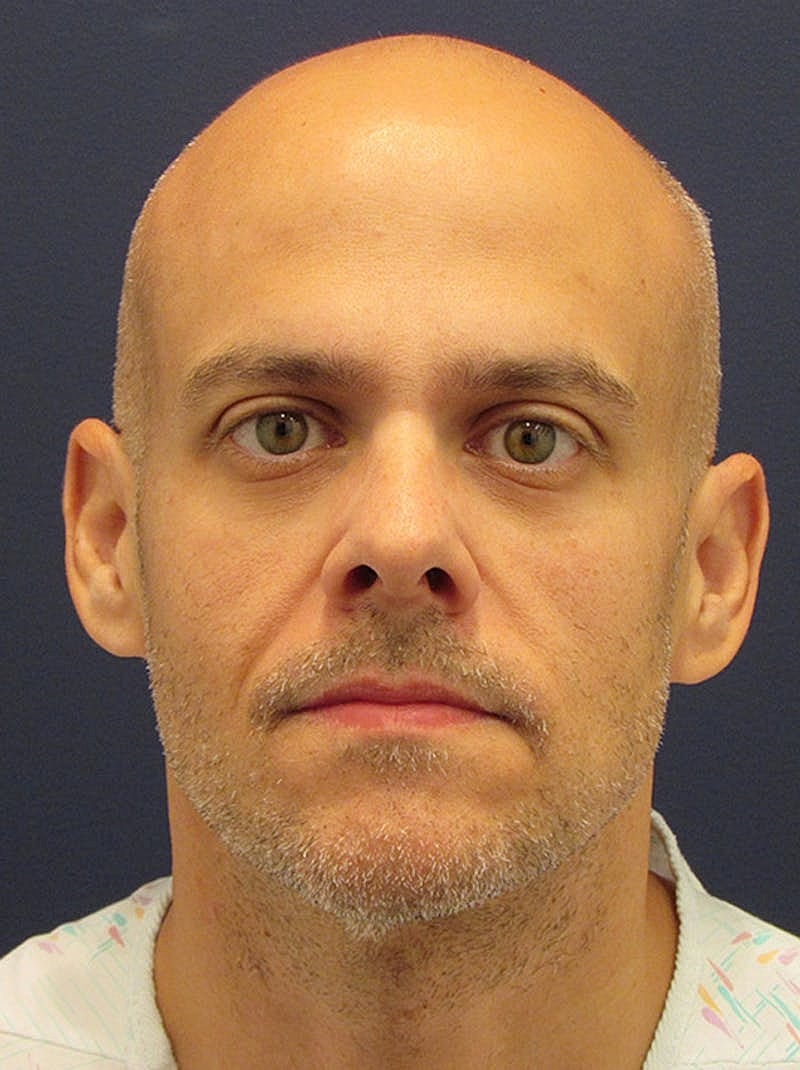 Facial Fat Graft Before & After