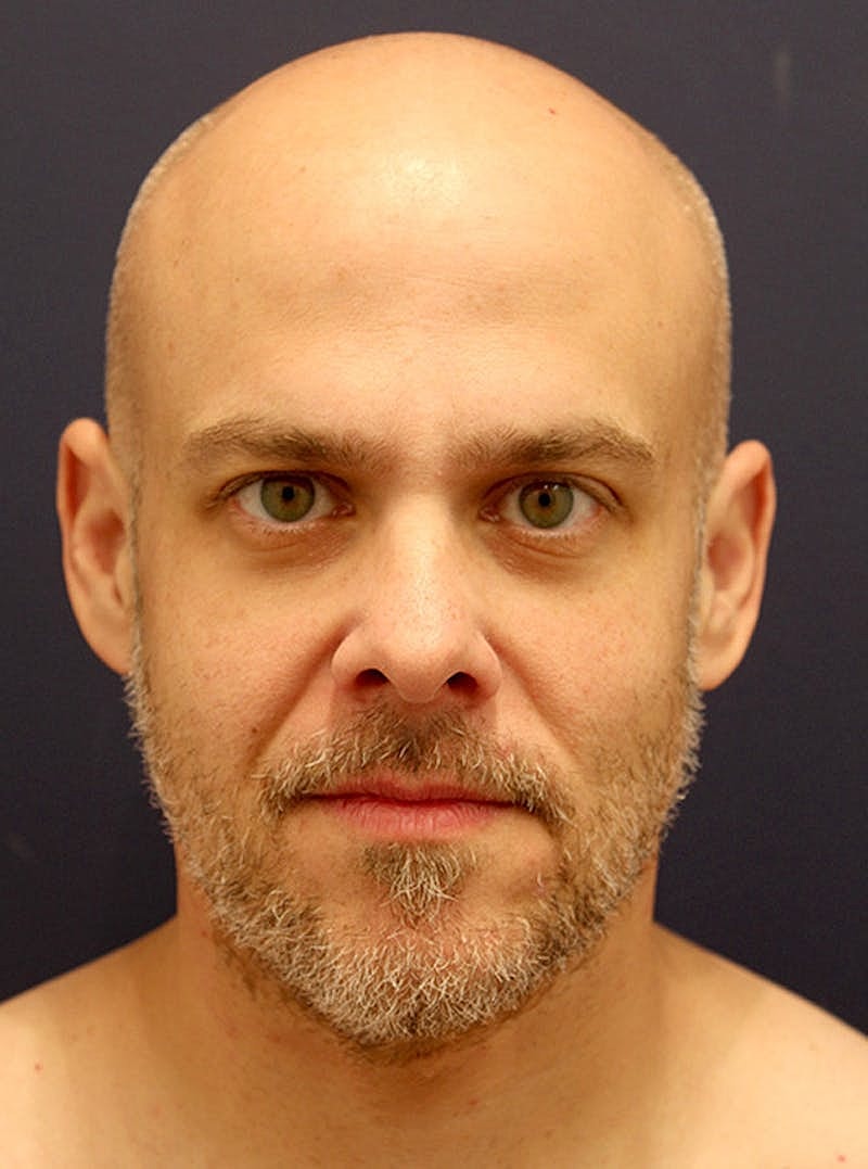 Facial Fat Graft Before & After