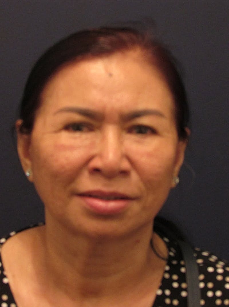 Facial Fat Graft Before & After