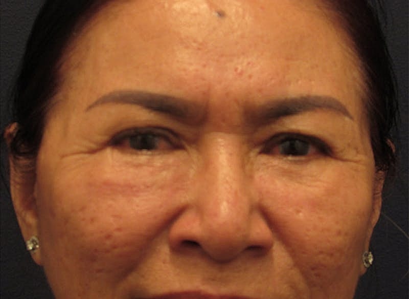 Facial Fat Graft Before & After