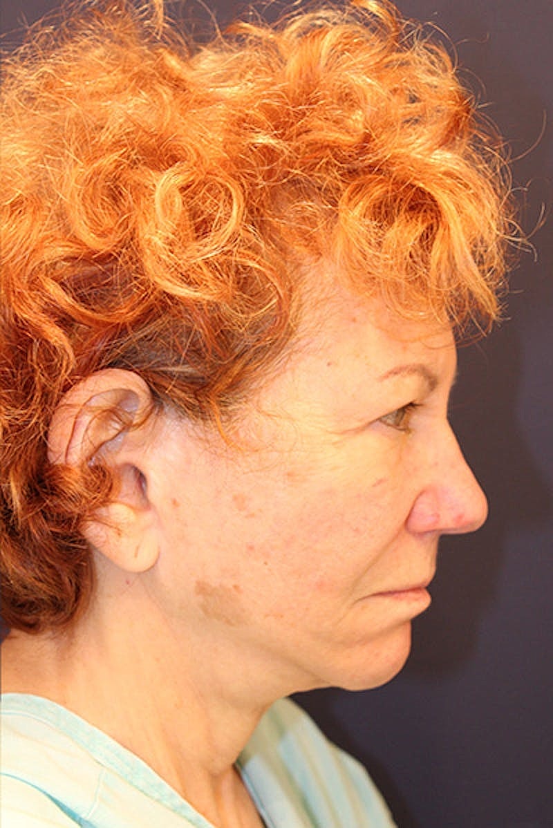 Facial Fat Graft Before & After