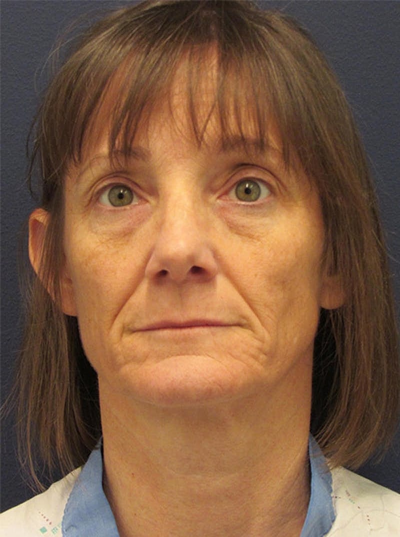 Facial Fat Graft Before & After