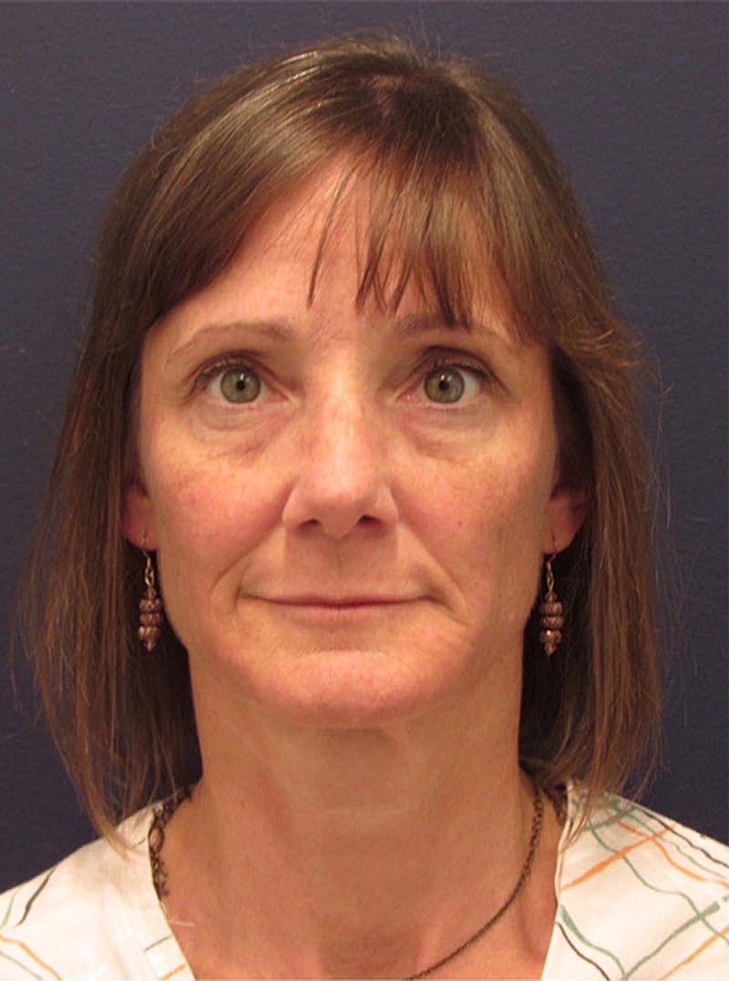 Facial Fat Graft Before & After