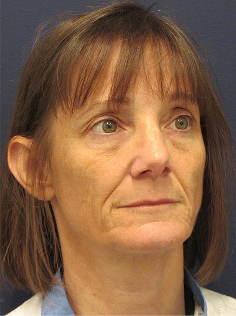 Facial Fat Graft Before & After