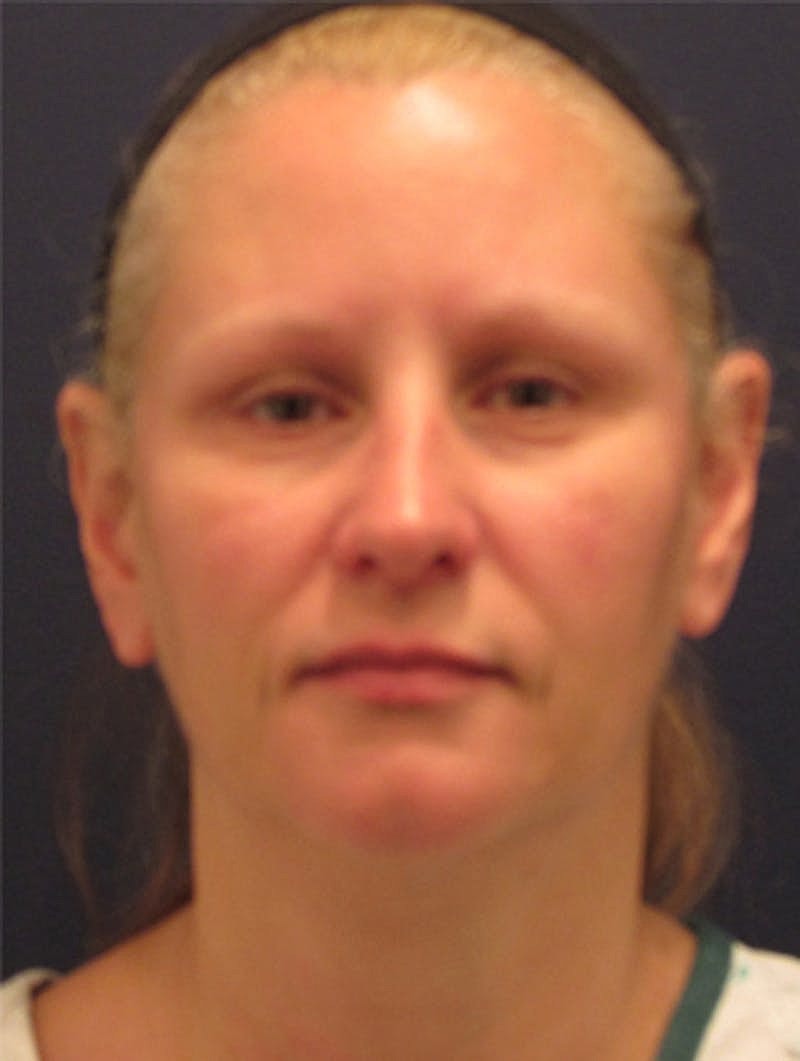 Facial Fat Graft Before & After