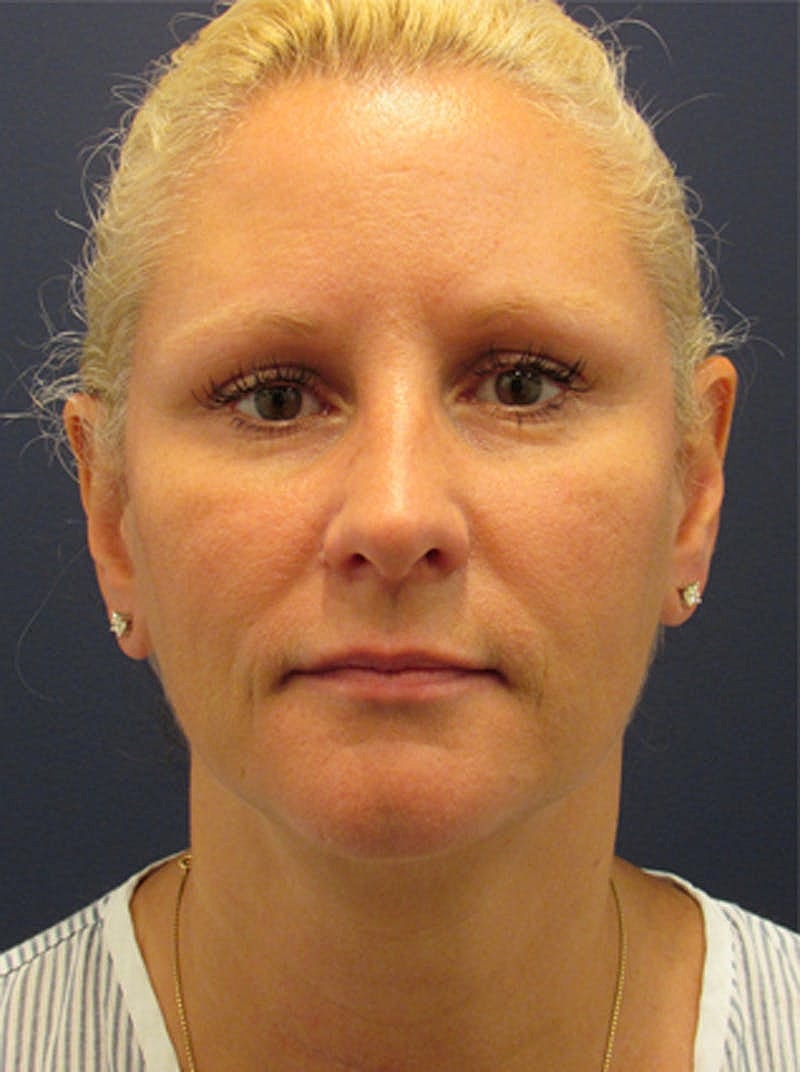 Facial Fat Graft Before & After