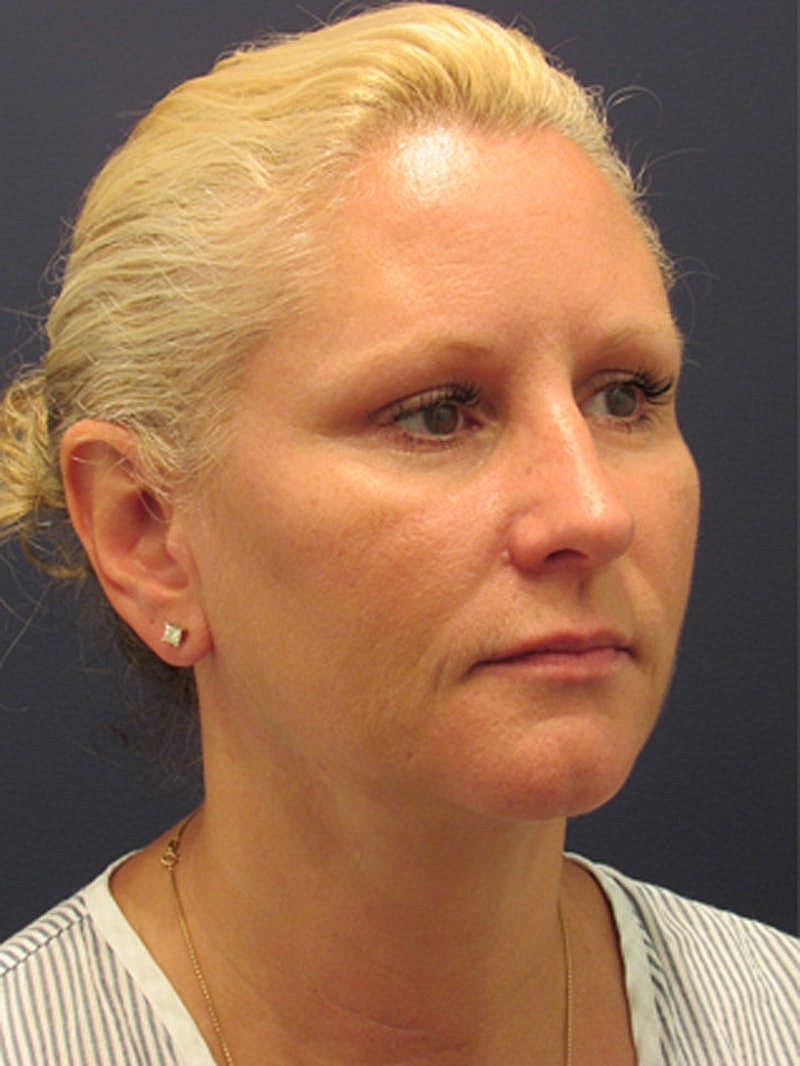 Facial Fat Graft Before & After