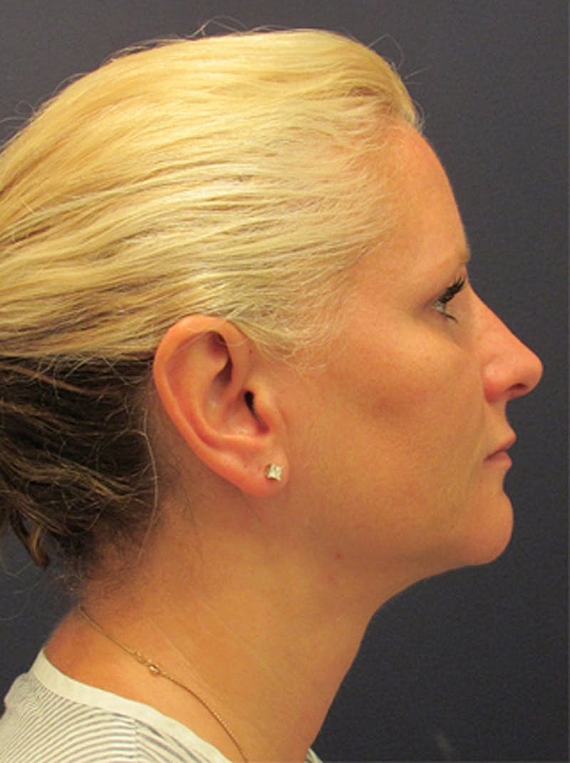 Facial Fat Graft Before & After