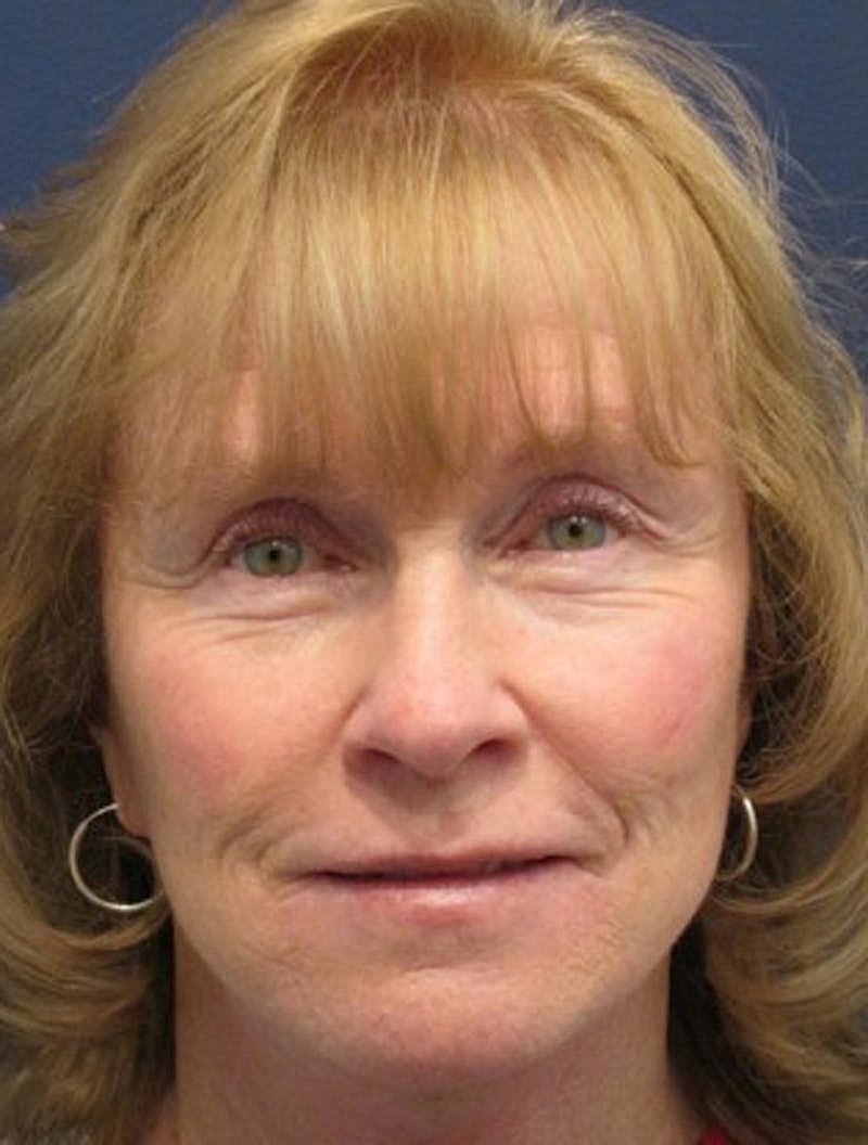 Facial Fat Graft Before & After