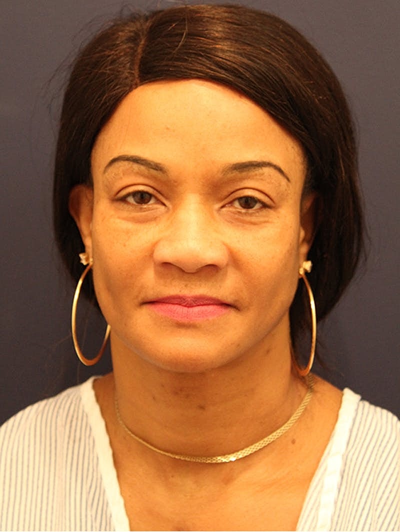 Facial Fat Graft Before & After