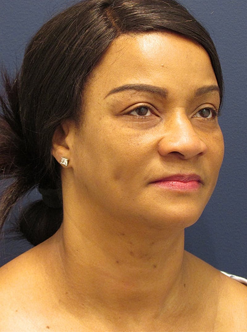 Facial Fat Graft Before & After