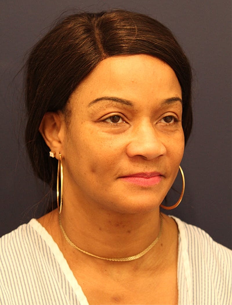 Facial Fat Graft Before & After