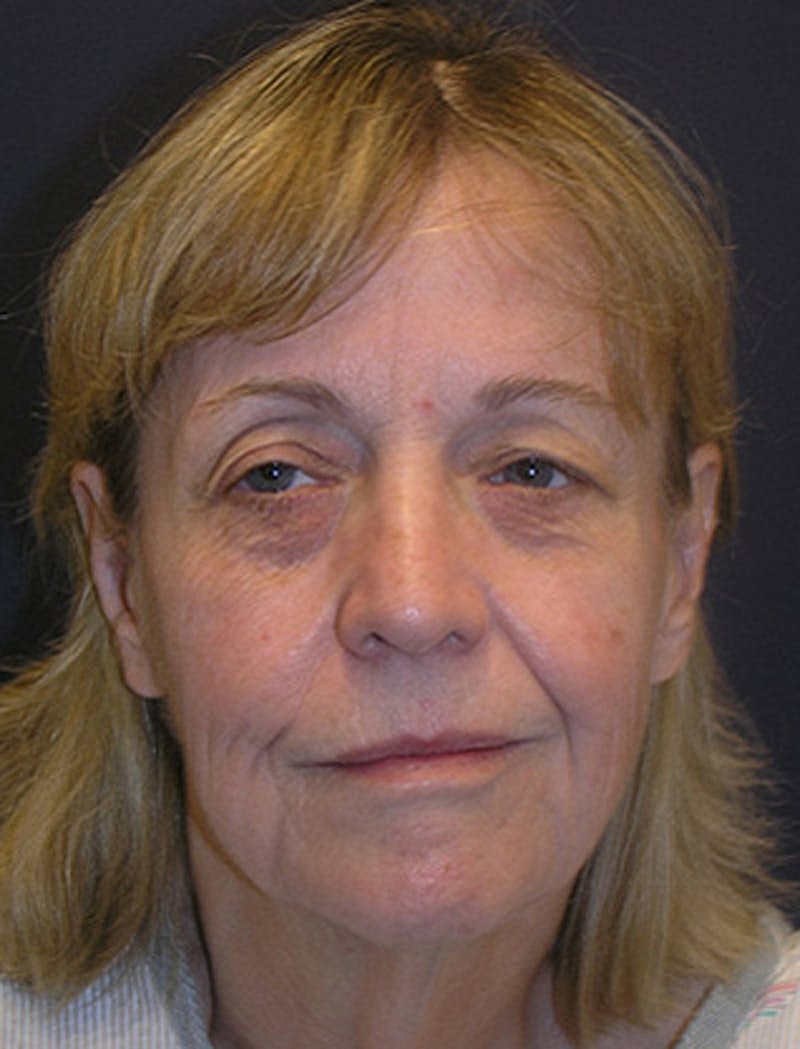 Facial Fat Graft Before & After