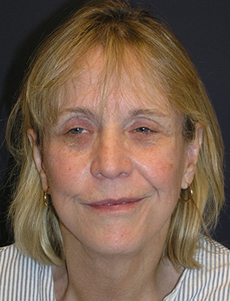 Facial Fat Graft Before & After