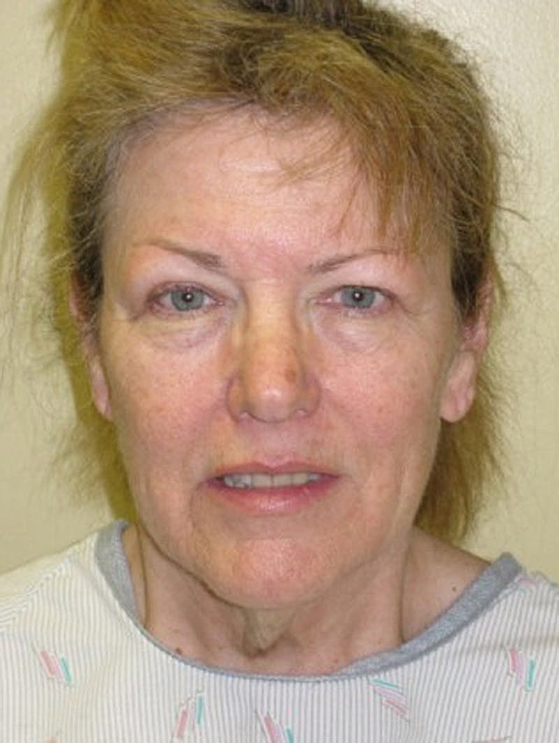 Facial Fat Graft Before & After