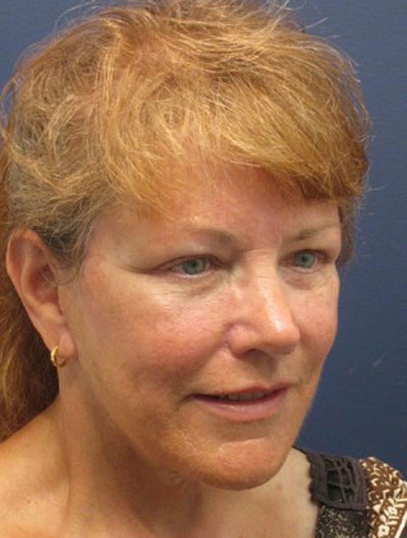 Facial Fat Graft Before & After