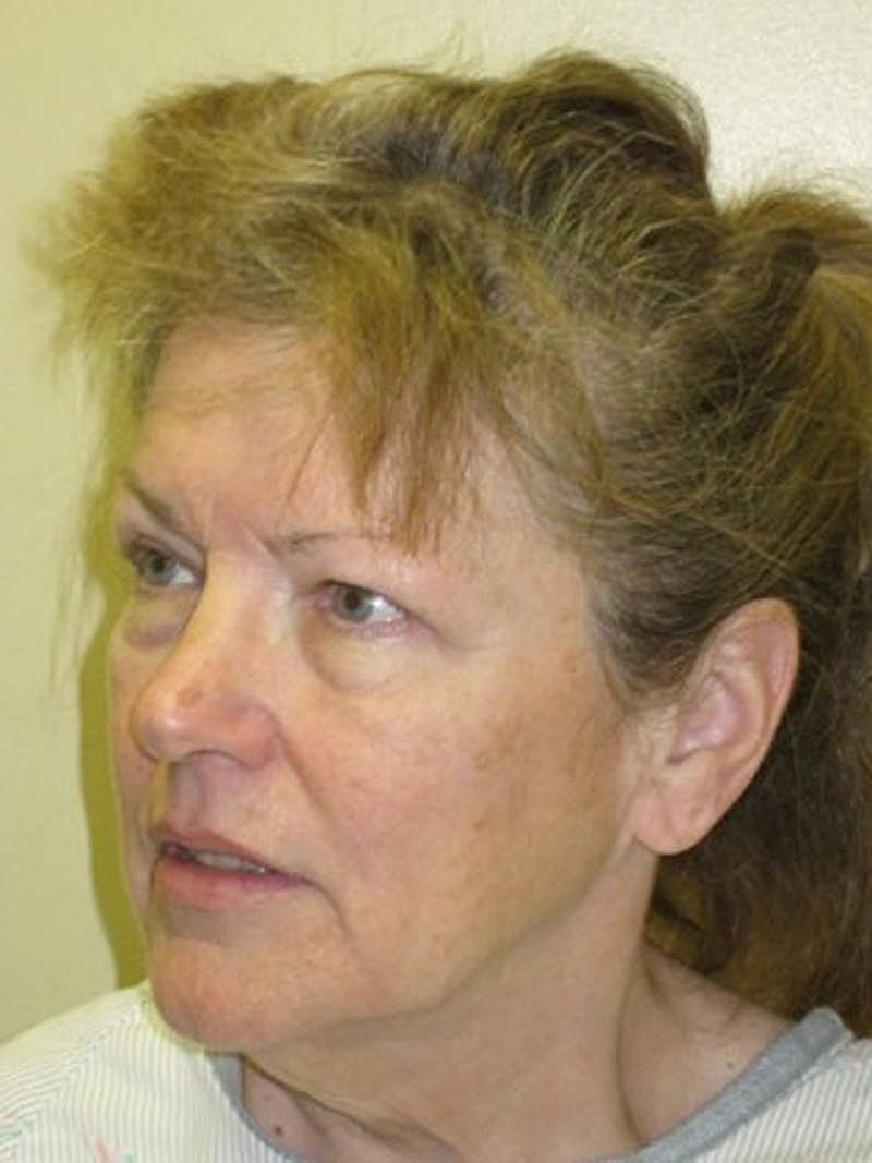 Facial Fat Graft Before & After