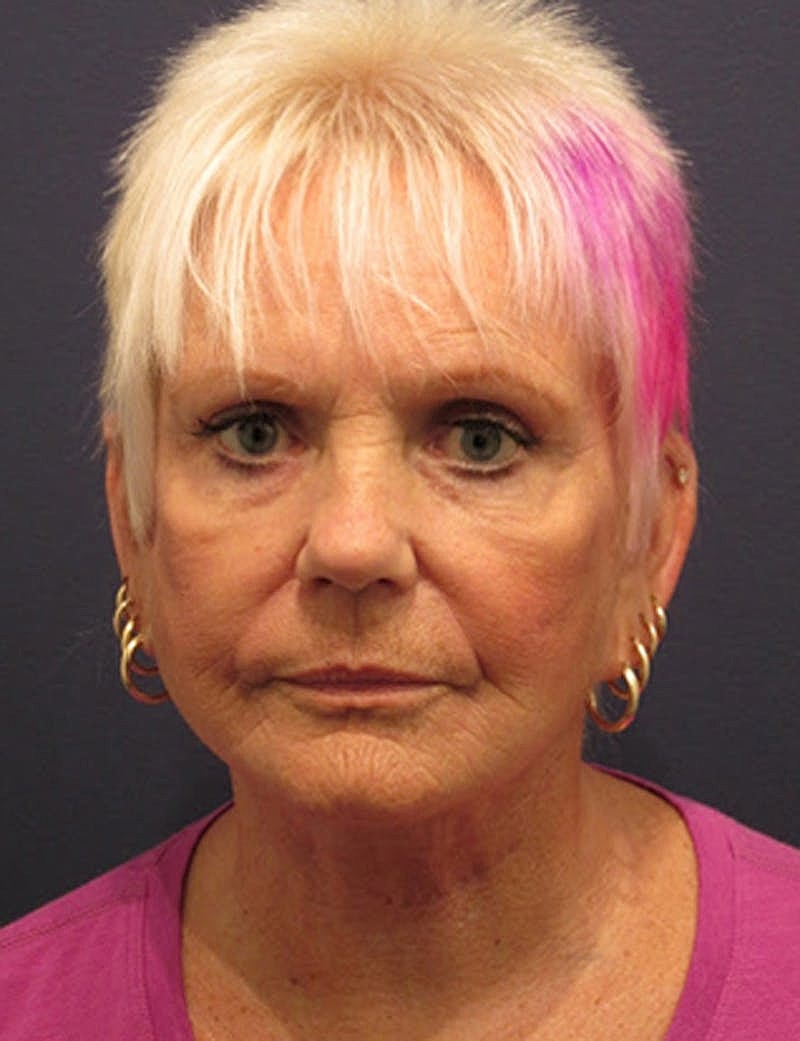 Facial Fat Graft Before & After