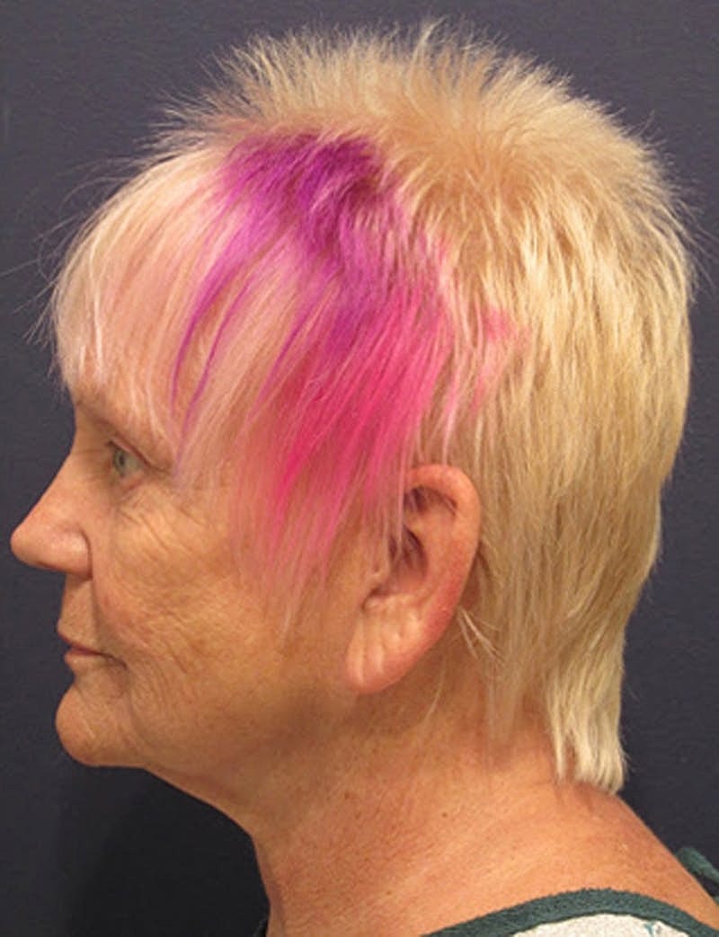 Facial Fat Graft Before & After