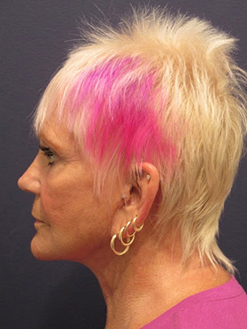 Facial Fat Graft Before & After