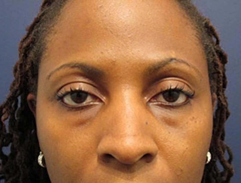 Facial Fat Graft Before & After