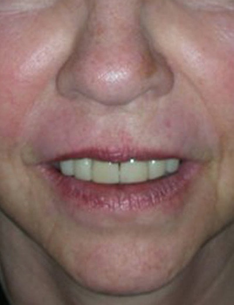 Facial Fat Graft Before & After