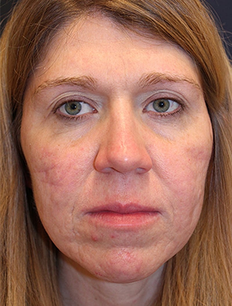 Facial Fat Graft Before & After