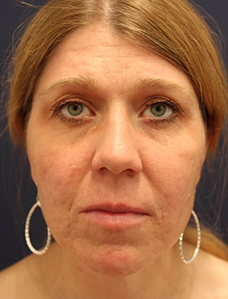 Facial Fat Graft Before & After