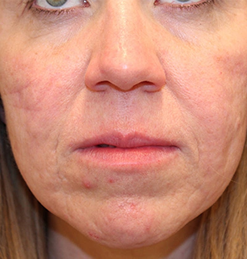 Facial Fat Graft Before & After