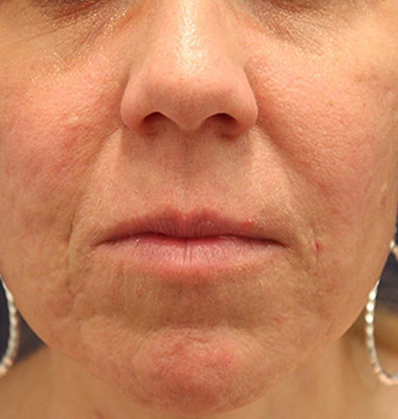 Facial Fat Graft Before & After