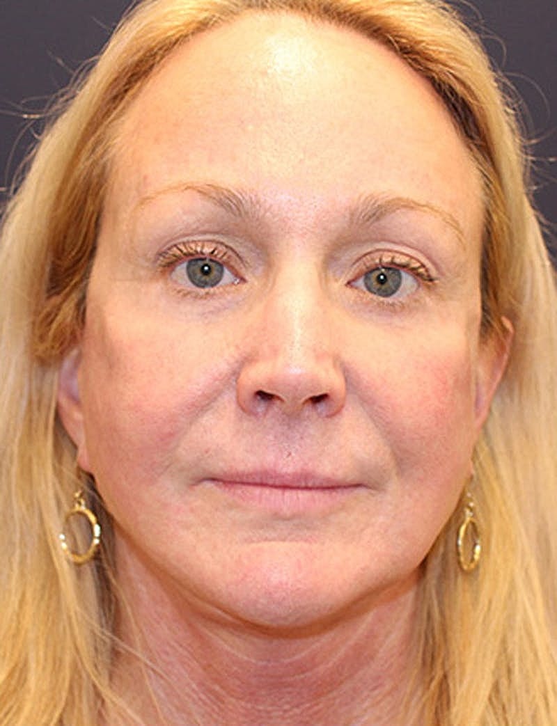 Facial Fat Graft Before & After