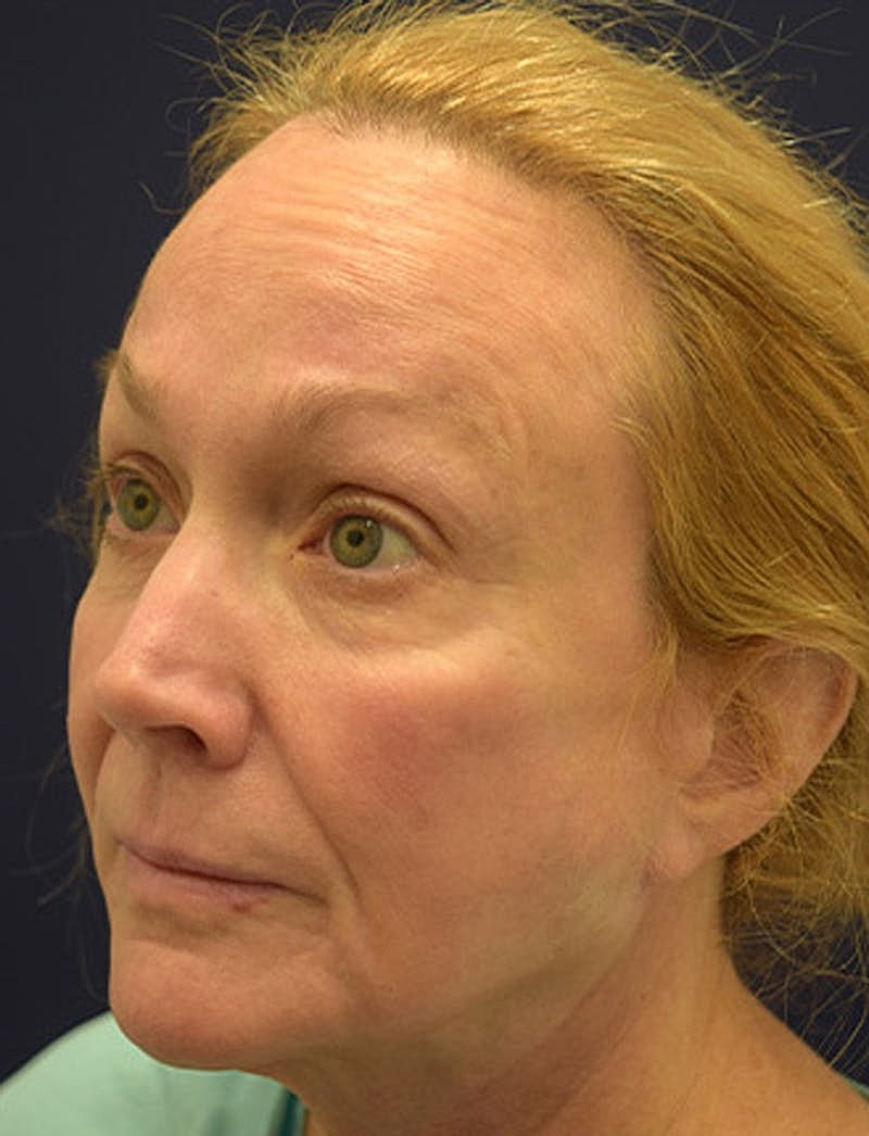 Facial Fat Graft Before & After