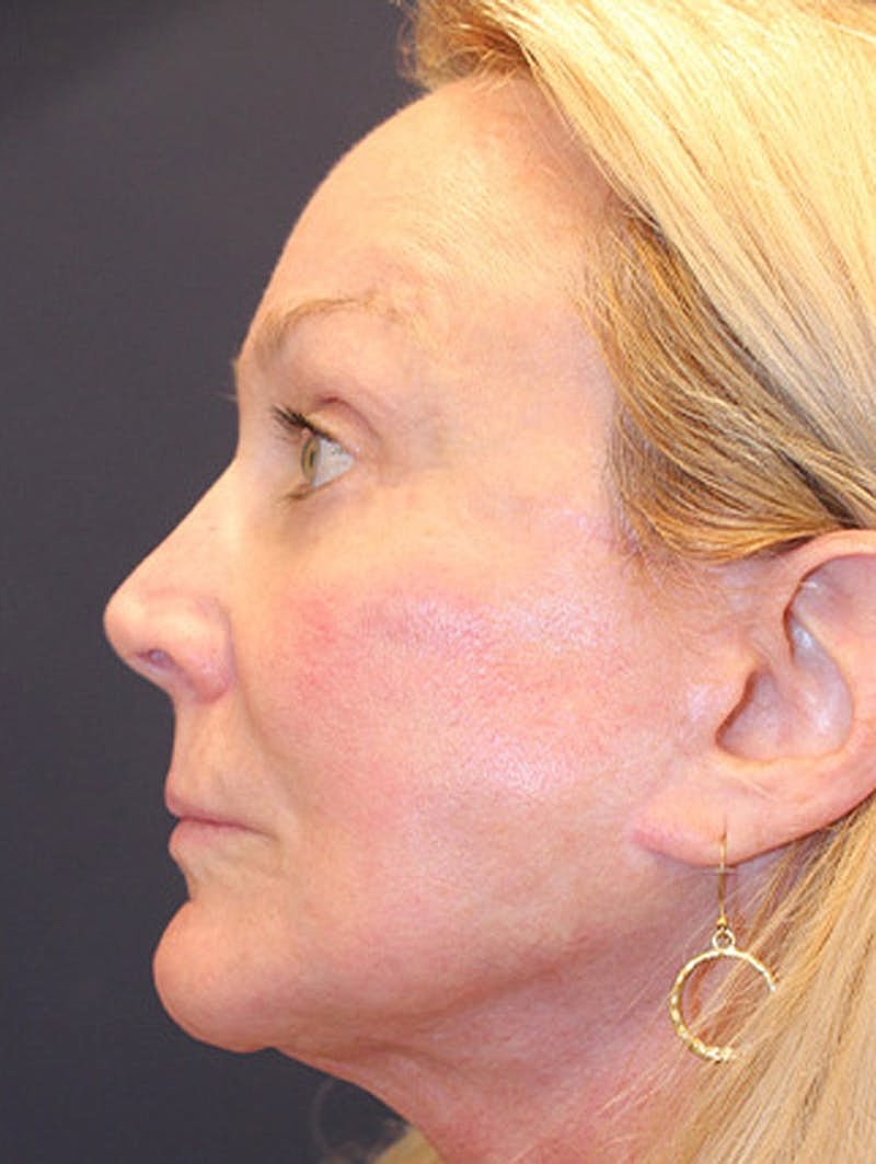 Facial Fat Graft Before & After