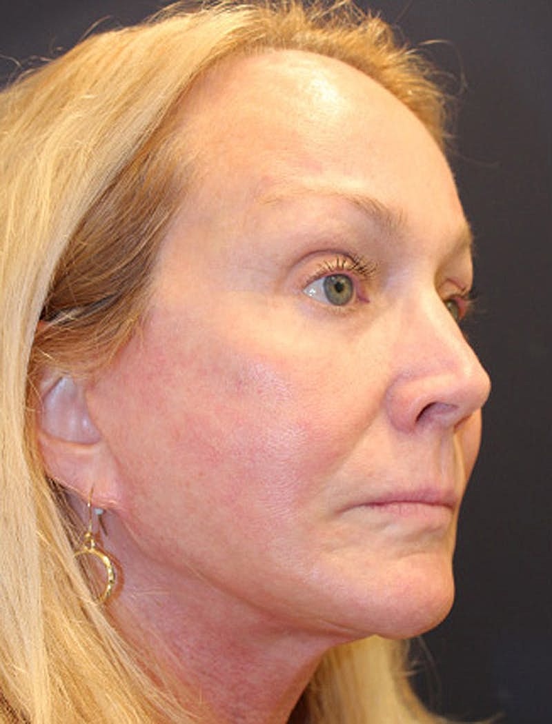 Facial Fat Graft Before & After