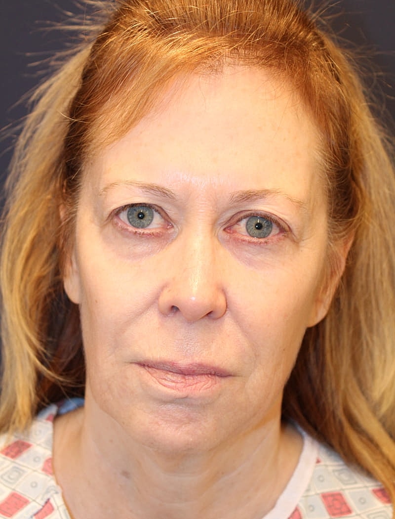 Facial Fat Graft Gallery Before & After