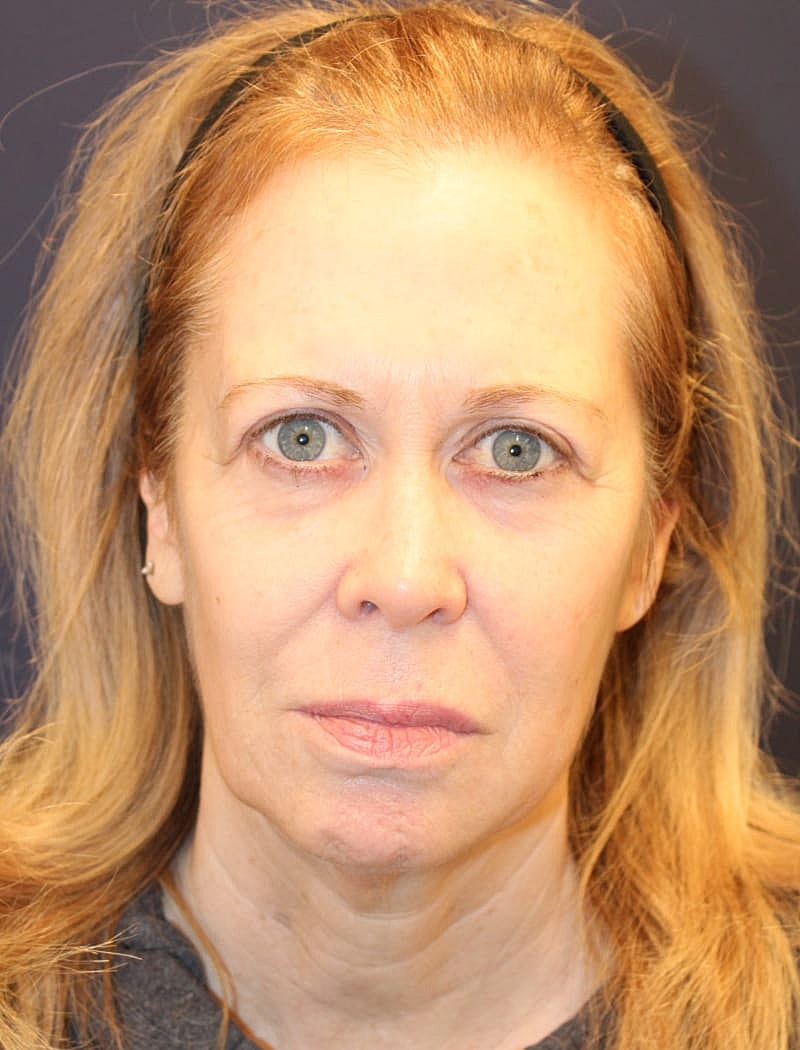 Facial Fat Graft Gallery Before & After