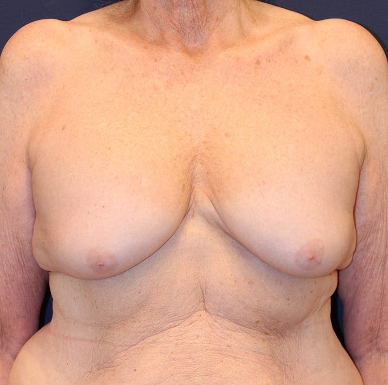 Breast Lift Before & After