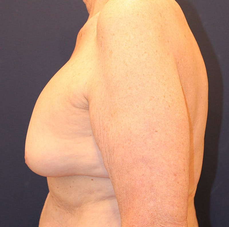 Breast Lift Before & After