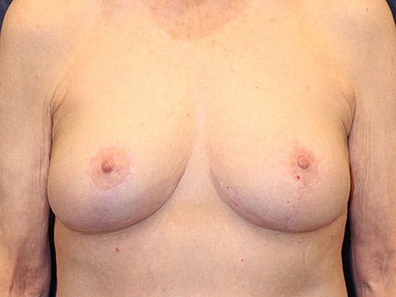 Breast Lift Before & After
