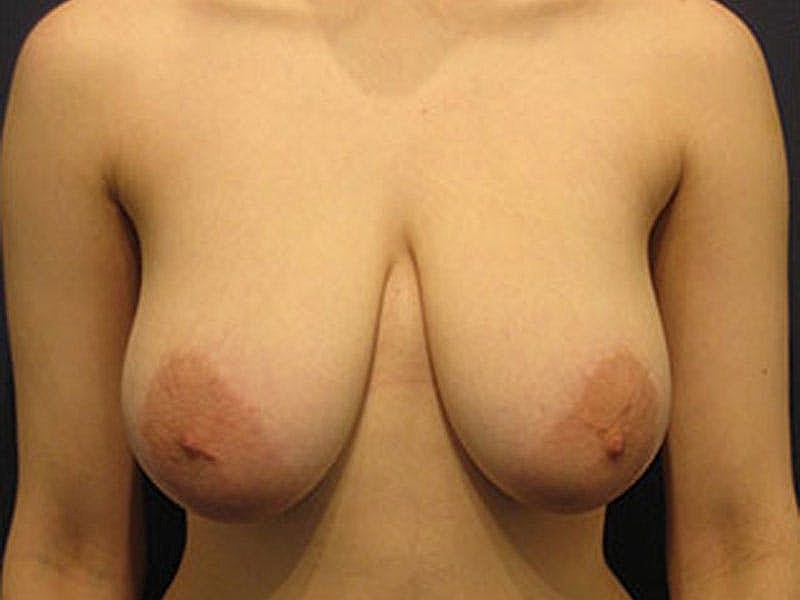 Breast Lift Before & After