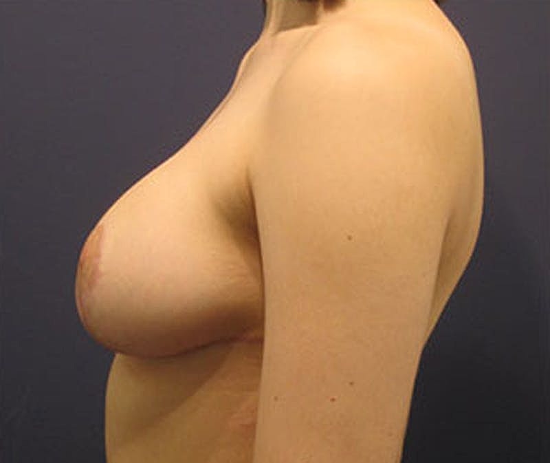 Breast Lift Before & After